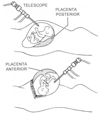 illustration of fetal intervention using endoscopy