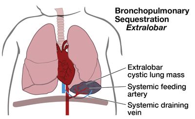 Illustration of baby with Bronchopulmonary Sequestration Extralobar