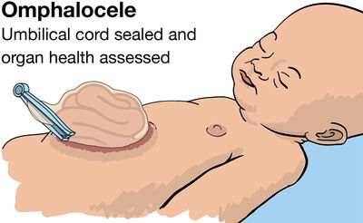 illustration of a baby omphalocele after birth with the umbilical cord sealed with a clip and the organs showing in membrane