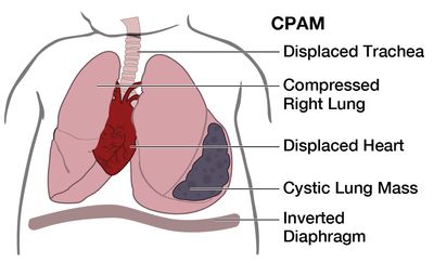 Illustration of baby with CPAM