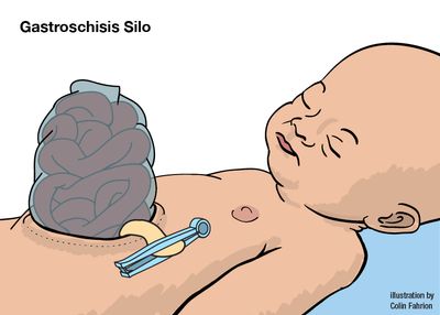 Illustration of baby with gastroschisis silo