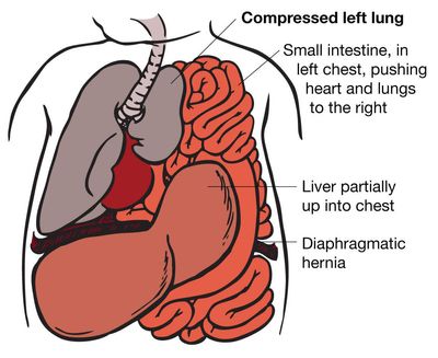 Illustration of CDH with lung compression