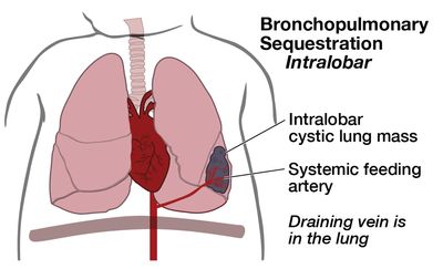 Illustration baby with Bronchopulmonary Sequestration Intralobar