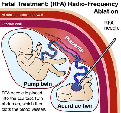 Illustration of Fetal Treatment of TRAP Sequence showing the radio frequency ablation needle inserted into the abdomen of the acardiac twin