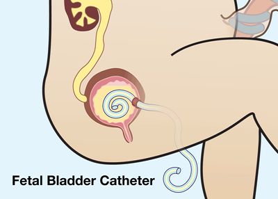 illustration of fetal bladder catheter