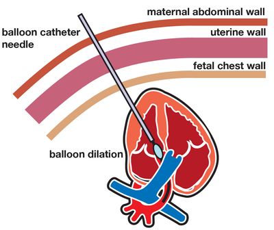 Congenital heart disease fetal treatment ballon catheter dilation 
