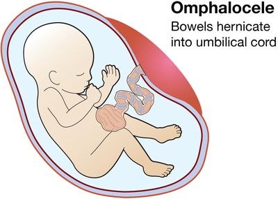 illustration of fetus with omphalocele