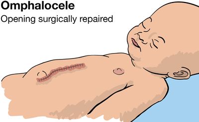illustration of baby with the omphalocele repaired showing the skin closed with medical staples