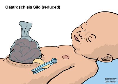 Illustration of baby with gastroschisis silo reduced