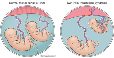 illustration of normal monochorionic twins compared with TTTS - ©chrisgralapp.com