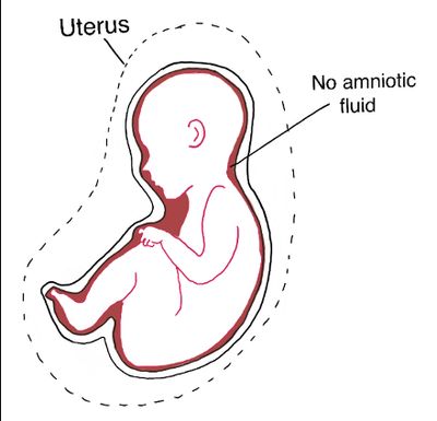 Illustration of fetus with no amniotic fluid