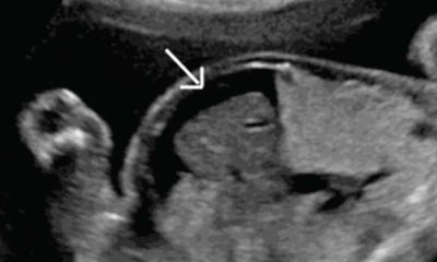 Ultrasound of fetus with hydrops