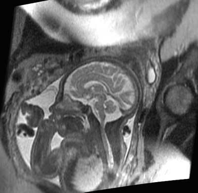 MRI of fetus in womb focused on cross section of brain