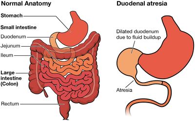 Illustration of normal anatomy of the bowels and and example of duodenal atresia