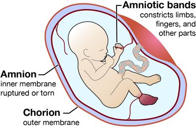 Illustration of fetus with amniotic band syndrome