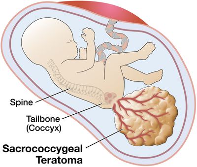 illustration of fetus with sacrococcygeal teratoma