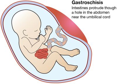 illustration of a fetus in the womb with gastroschisis, intestines protruding out of the abdomen near the umbilical cord