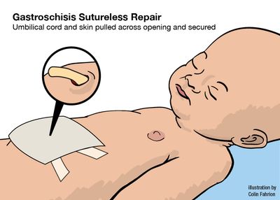 Illustration of baby with sutureless repair of gastroschisis