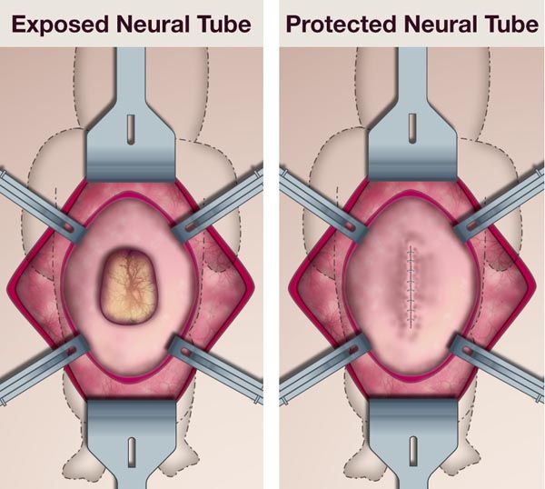 illustration of open fetal surgery for Spina Bifida (Myelomeningocele)