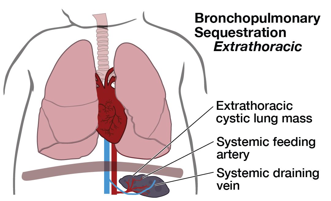 Illustration of baby with Bronchopulmonary Sequestration Extrathoracic"