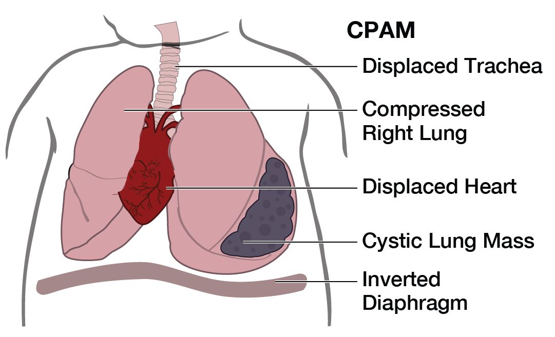 Illustration of baby with CPAM