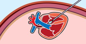 illustration of balloon aortic valvuloplasty