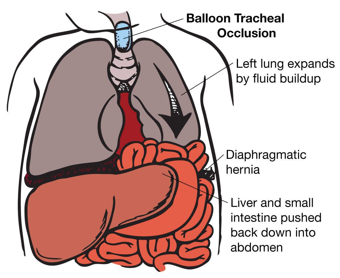 Illustration of CDH balloon tracheal occasion