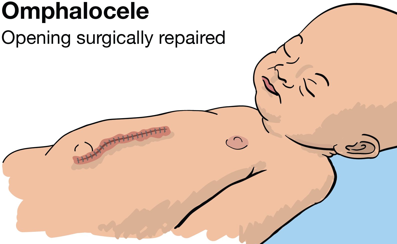 illustration of baby with the omphalocele repaired showing the skin closed with medical staples