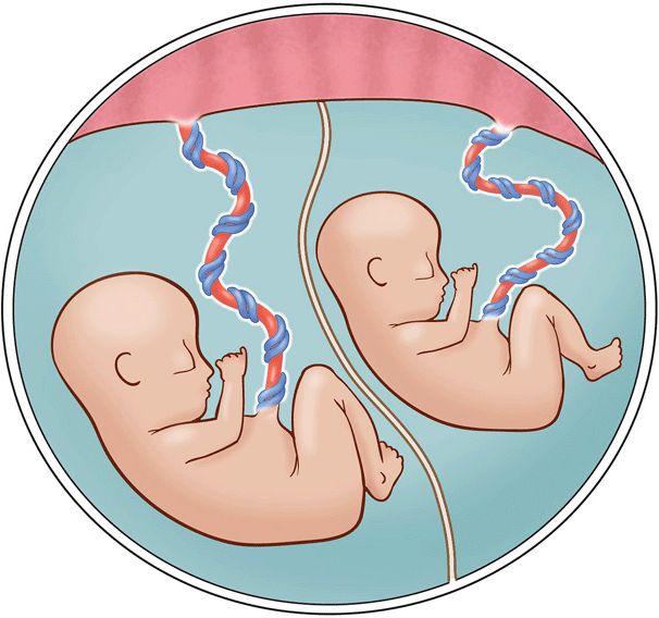 illustration of monochorionic twins - ©chrisgralapp.commedical