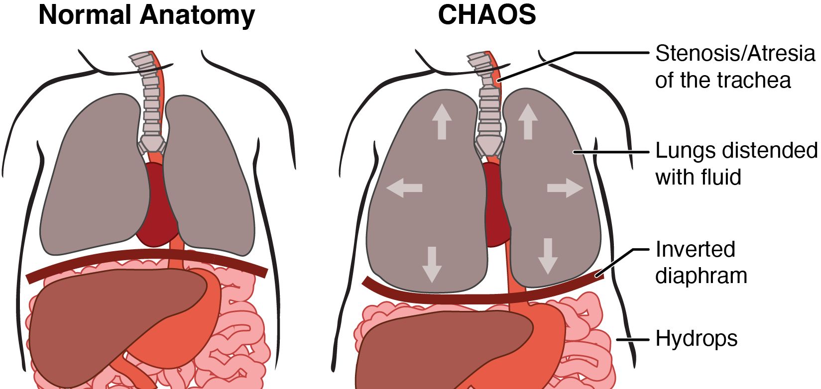 Illustration of normal fetal lung anatomy and a fetus with CHAOS showing stenosis of the trachea and distended lungs, inverted diaphragm and hydrops in the abdomen