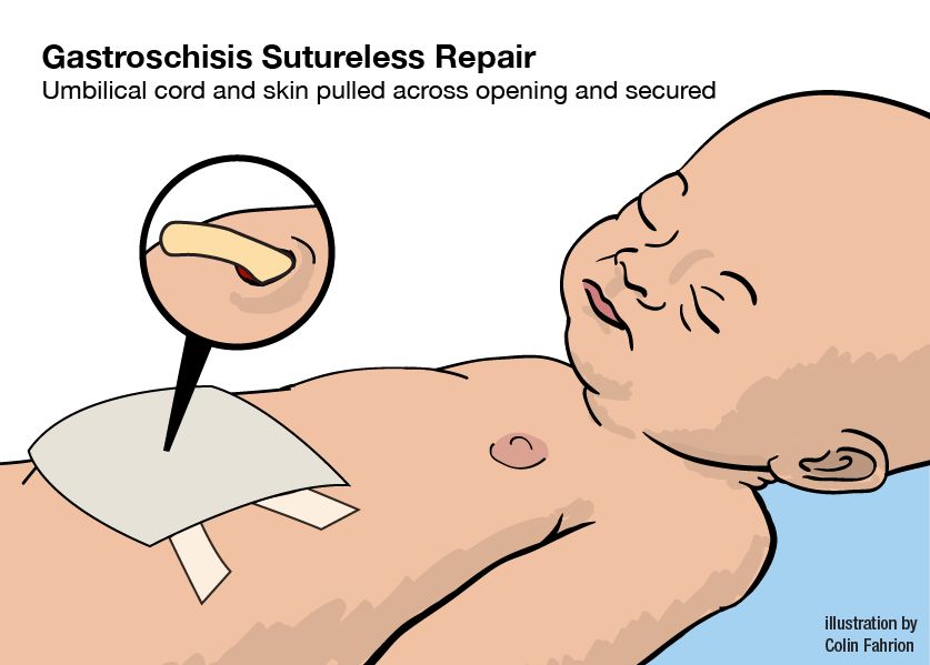 Illustration of baby with sutureless repair of gastroschisis