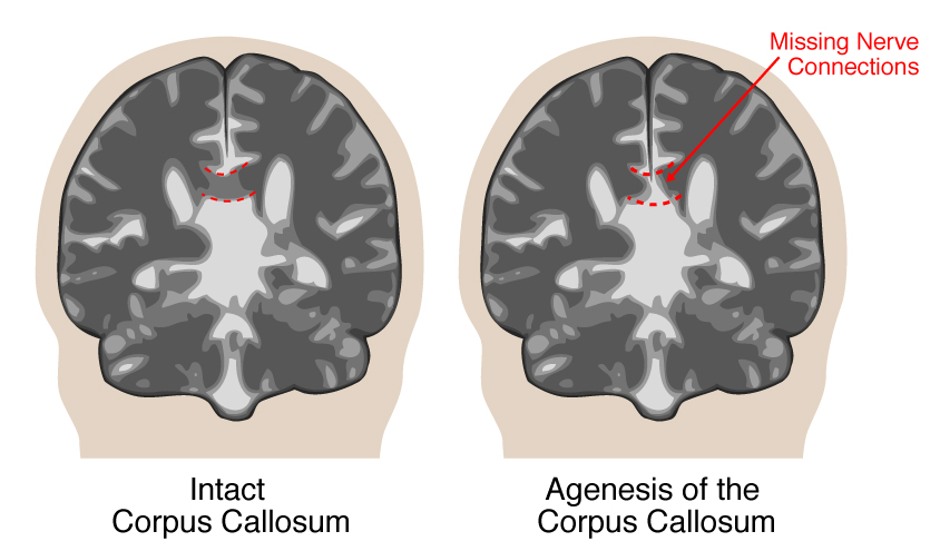 Agenesis of the Corpus Callosum | UCSF Fetal Treatment Center