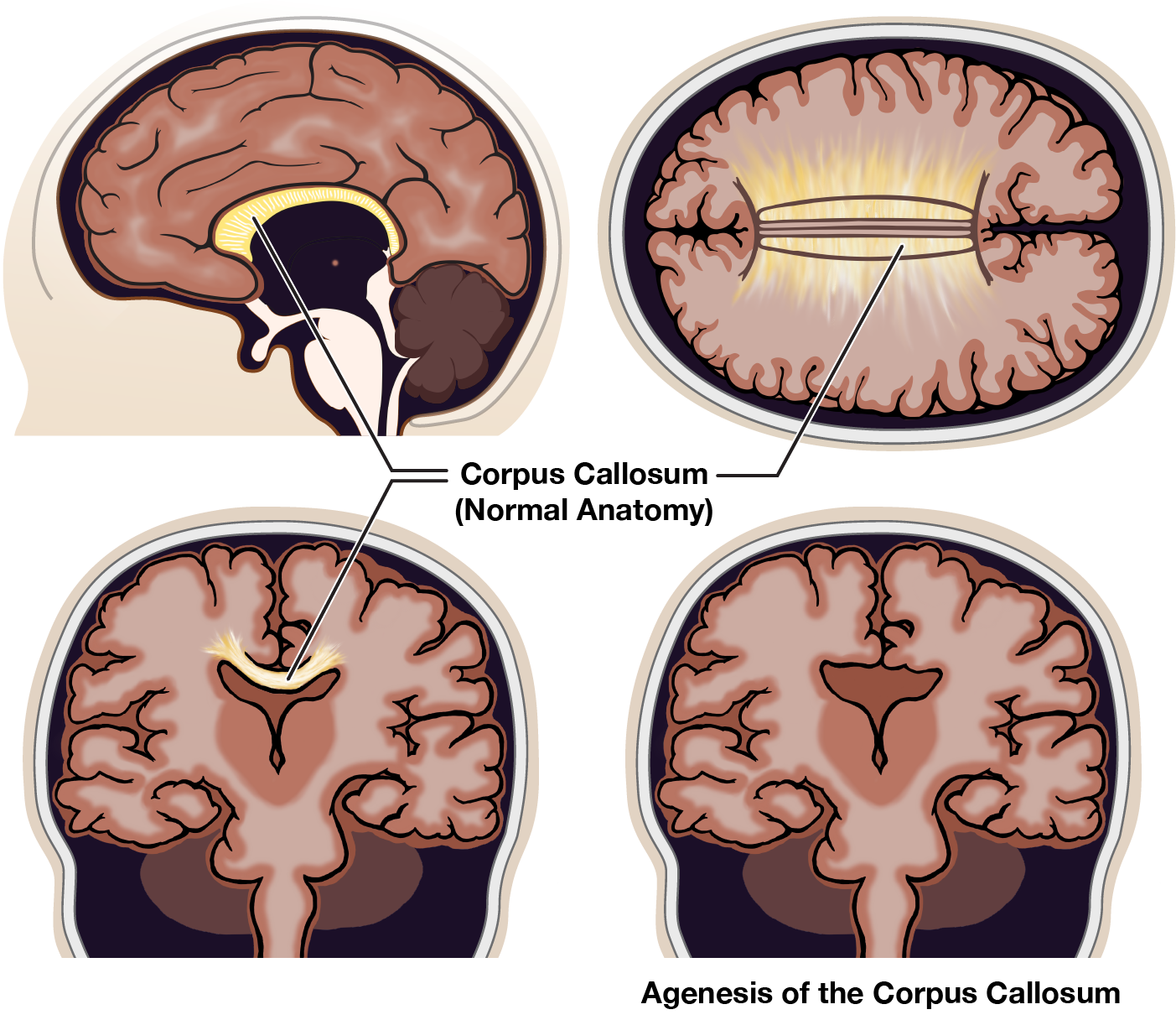 illustration of intact callosum compared to the missing nerve connections with agenesis of the corpus callosum