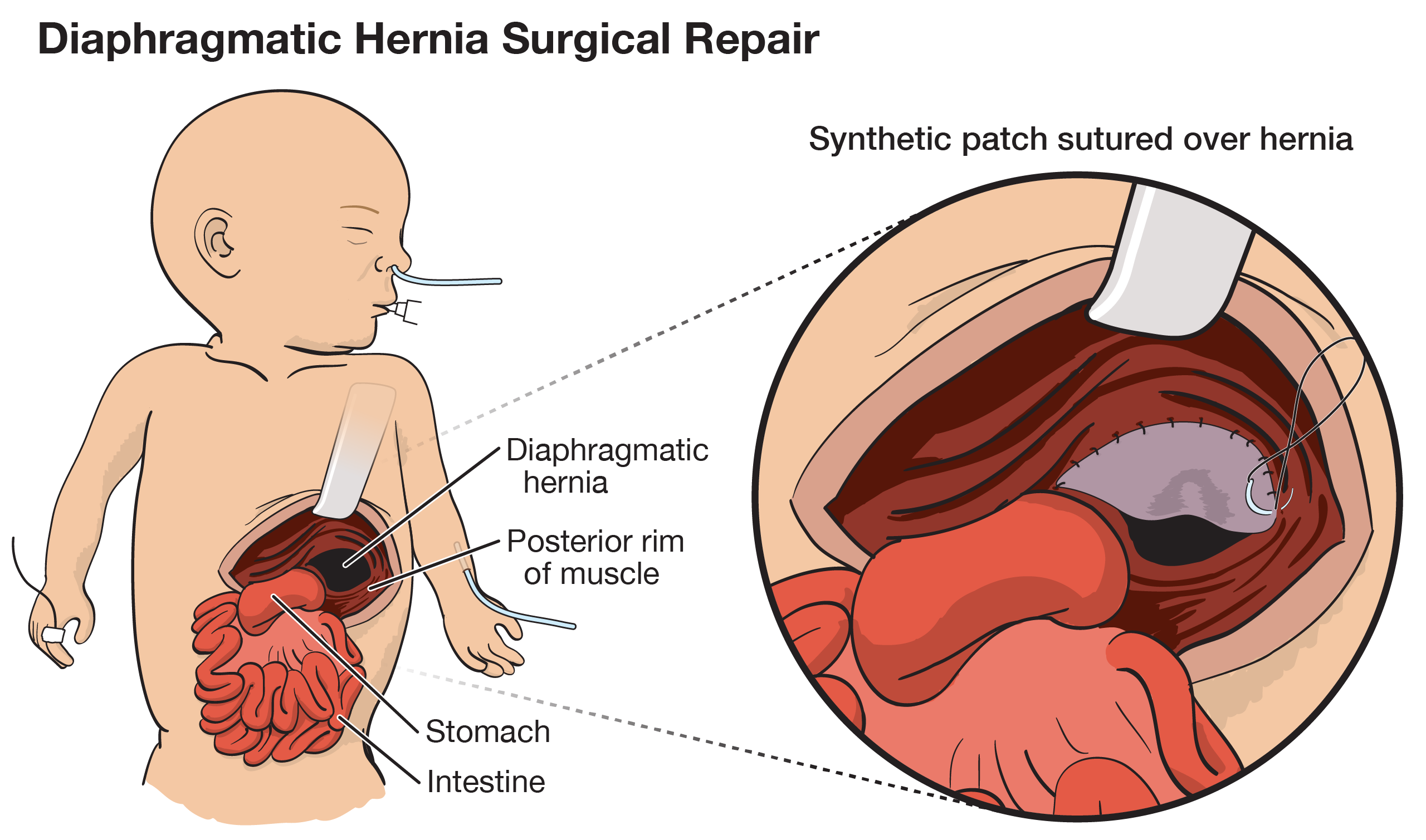 Illustration of diaphragmatic surgical repair using a synthetic patch