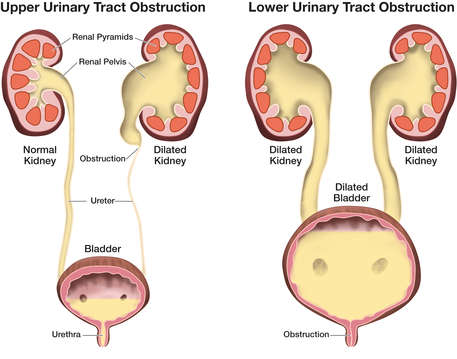 illustration of upper and lower urinary tract obstruction