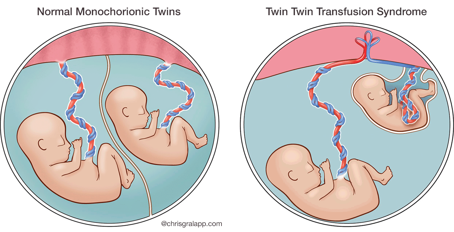 illustration of normal monochorionic twins compared with TTTS - ©chrisgralapp.com