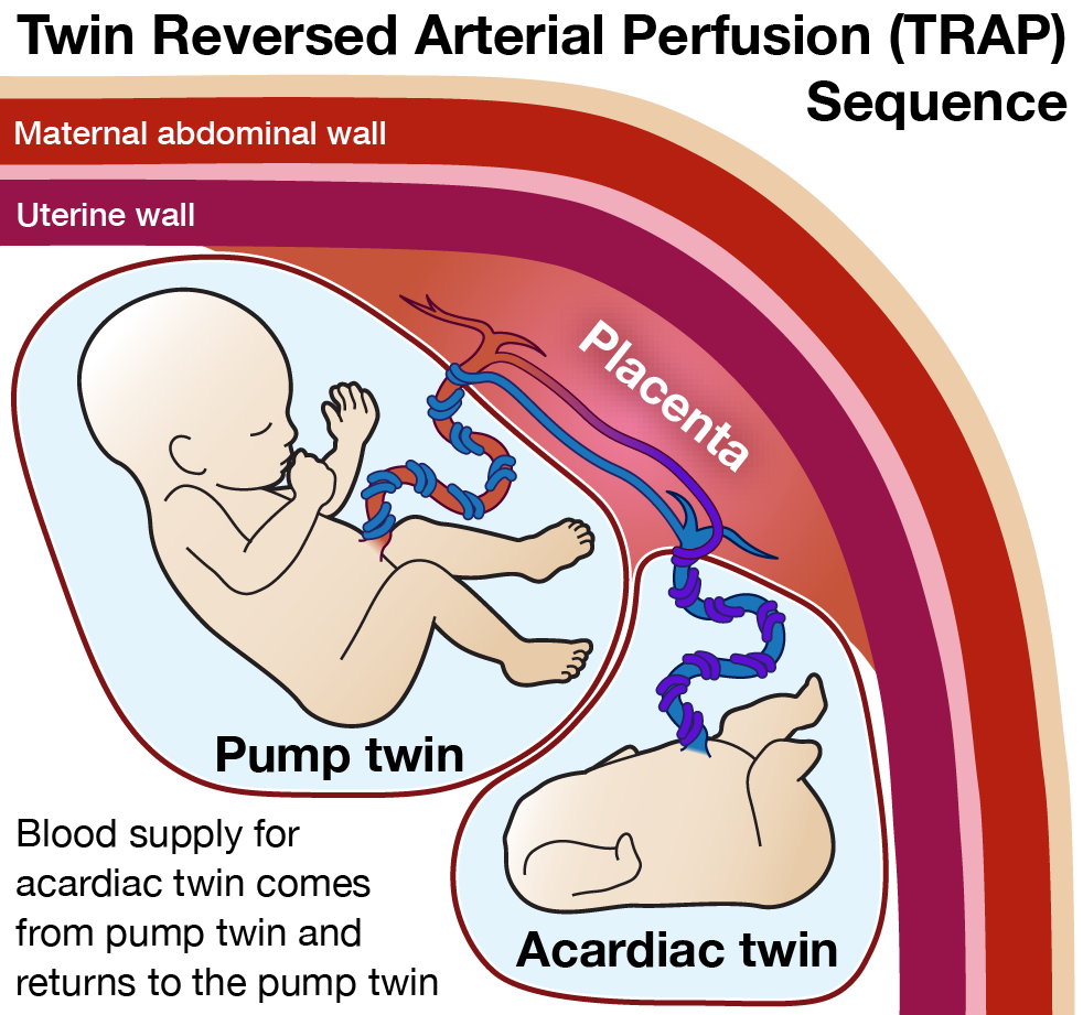 Illustration of TRAP Sequence showing shared blood vessels and blood pumping into the acardiac twin from the pump twin