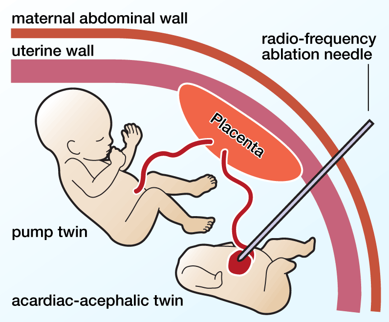 TRAP Sequence: Radio Frequency Ablation (illustration by Colin Fahrion)