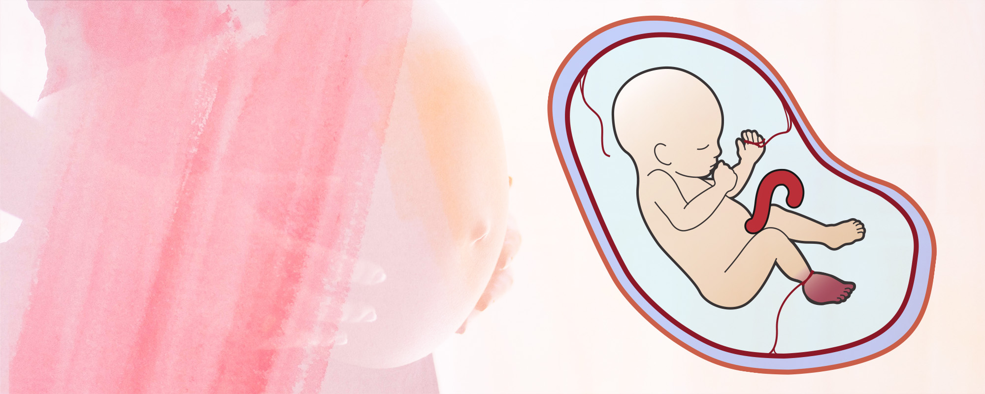 Illustration of baby in womb with amniotic band syndrome