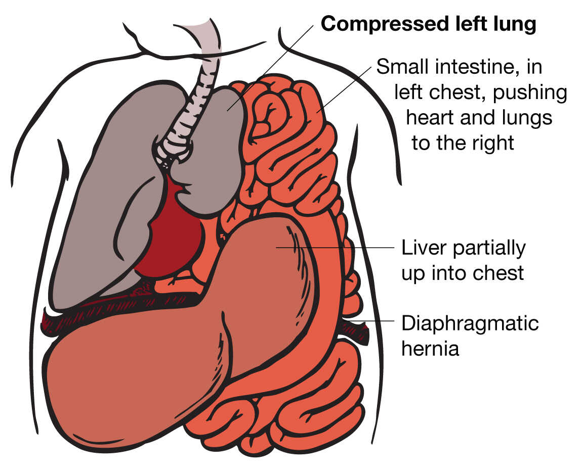 Illustration of CDH with lung compression