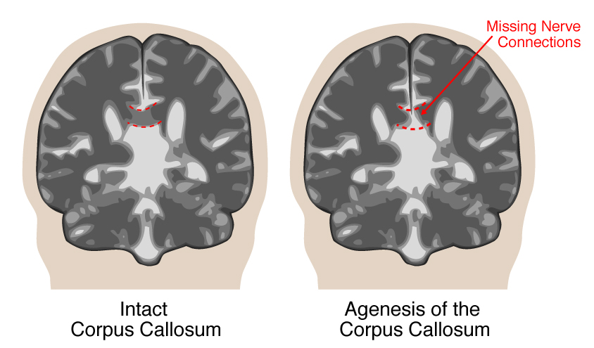 illustration of intact callosum compared to the missing nerve connections with agenesis of the corpus callosum