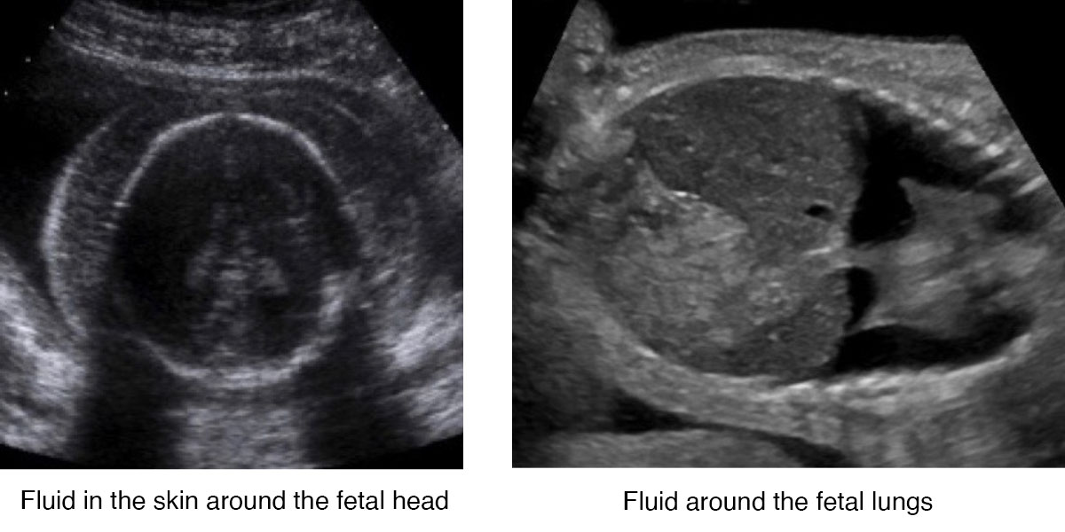 Ultrasound image showing hydrops fetalis fluid around head and lungs of the fetus