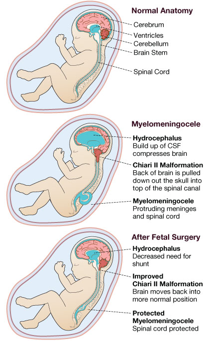 Anatomy illustration of Spina Bifida (Myelomeningocele) along with Chiari II malformation