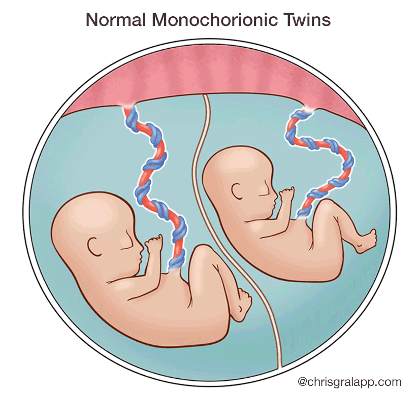 illustration of normal monochorionic twins - ©chrisgralapp.com