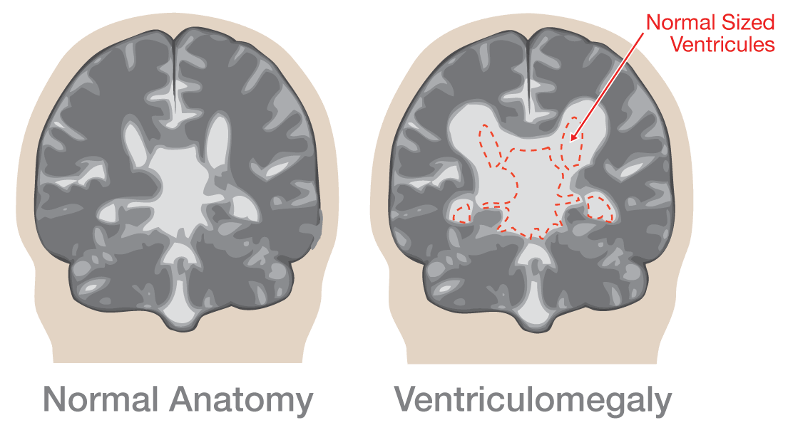 illustration of ventriculomegaly