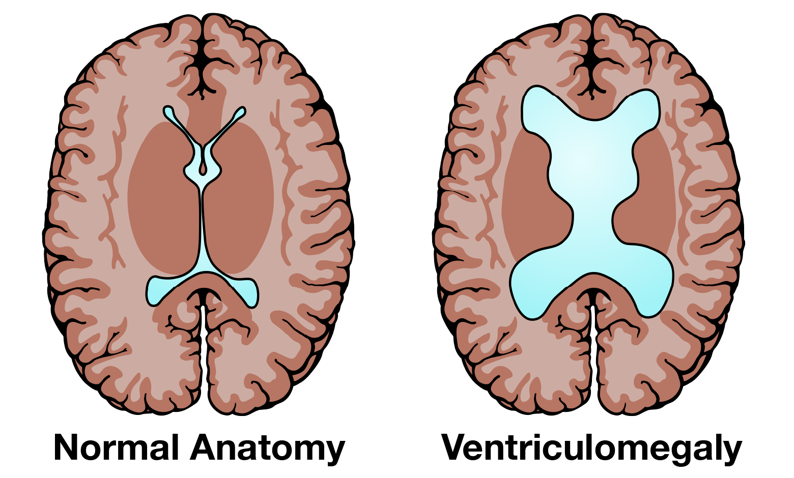 الخرف الناتج عن استسقاء الرأس الطبيعي حيث تظهر الصورتضخم لقنوات وحجرات السائل الدماغي الشوكي داخل الدماغ ( اليمين ) ومقارنته مع الحجم الطبيعي ( اليسار )